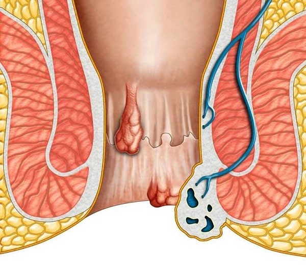 Nguyên nhân gây đau hậu môn sau khi đi đại tiện