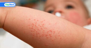 Trẻ bị rôm sảy và hăm tã: Mẹ phải làm sao?