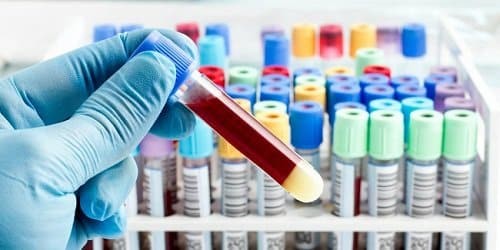 Xét nghiệm máu giúp dễ dàng đánh giá tế bào máu của bệnh nhân để tìm ra nguyên nhân gây bệnh một cách chính xác nhất