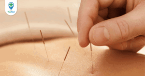 Dịch vụ châm cứu tại bệnh viện Y học Cổ truyền