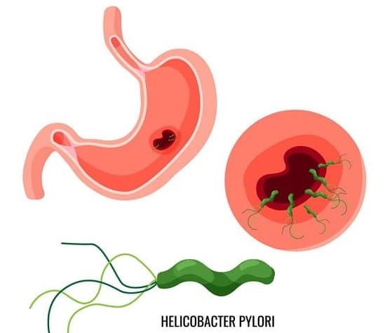 Helicobacter pylori được xem là nguyên nhân ung thư dạ dày