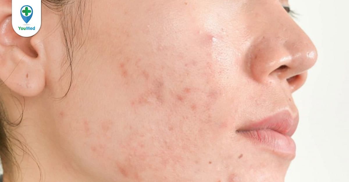 Mụn viêm có nhân có thể gây tổn thương nghiêm trọng cho da không?
