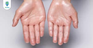 Tăng tiết mồ hôi tay chân