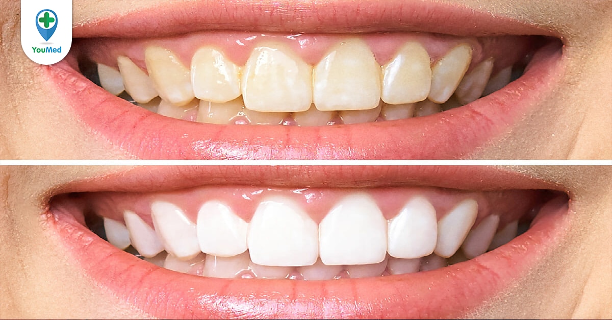 Cách tẩy răng ố vàng