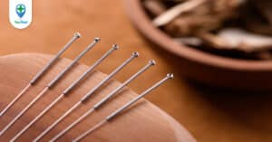 Người bị tai biến có nên châm cứu hay không?