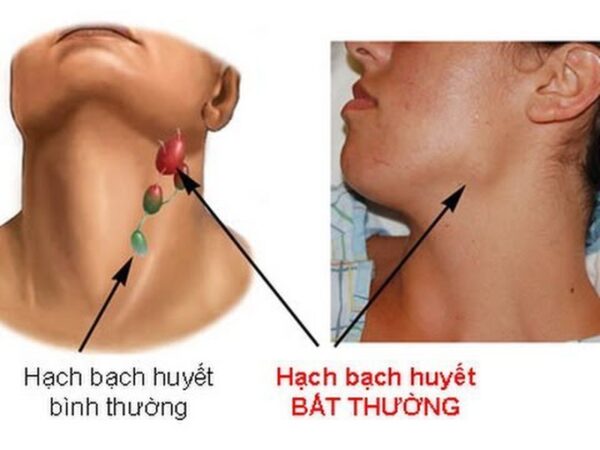 Hạch bạch huyết sưng to bất thường có thể là dấu hiệu ung thư máu