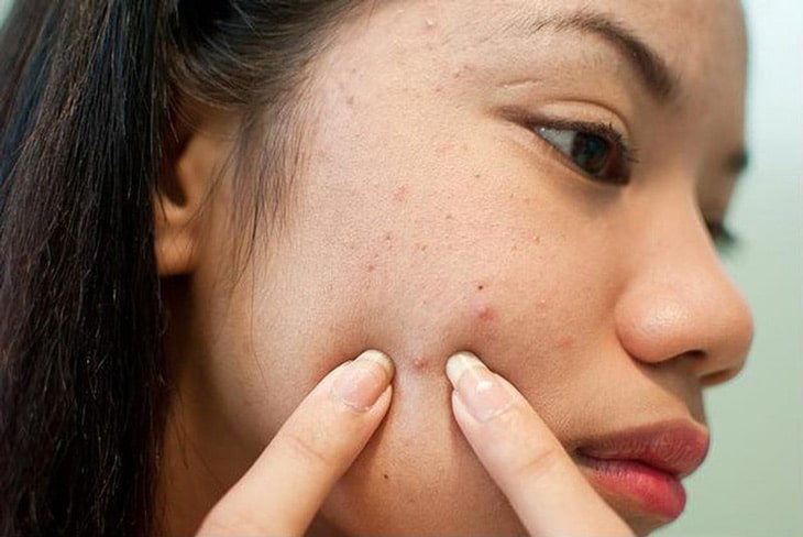 Tăng tiết dầu do tăng Androgen, tăng sừng nang lông, vi khuẩn C.Acnes và phản ứng viêm có thể là nguyên nhân gây ra mụn ở tuổi dậy thì