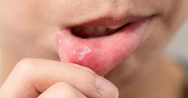 Nhiệt miệng là bệnh lý thường gặp khó phân biệt với sùi mào gà ở môi trong giai đoạn đầu