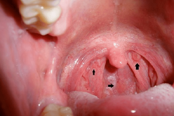 Các nốt mụn nhỏ xuất hiện rải rác ở vòm họng là dấu hiệu sùi mào gà ở họng giai đoạn đầu