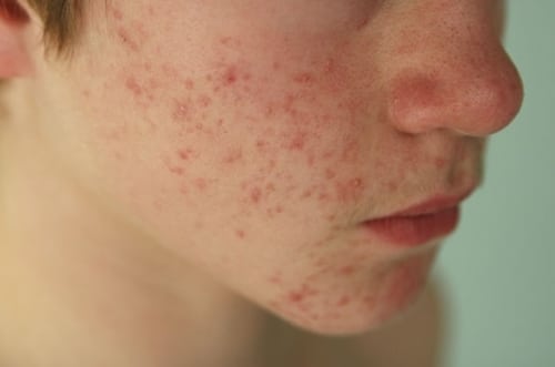 mun-trung-ca-phuong-phap-de-dieu-tri-hieu-qua