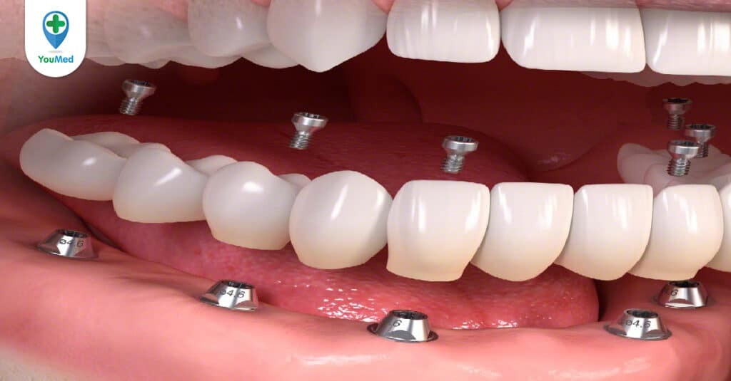 Trồng răng implant