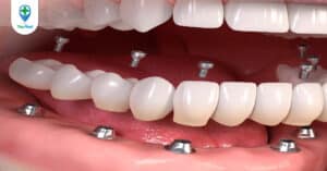 Review trồng răng Implant ở bệnh viện Răng Hàm Mặt