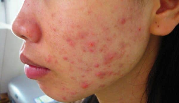 mun-trung-ca-phuong-phap-de-dieu-tri-hieu-qua