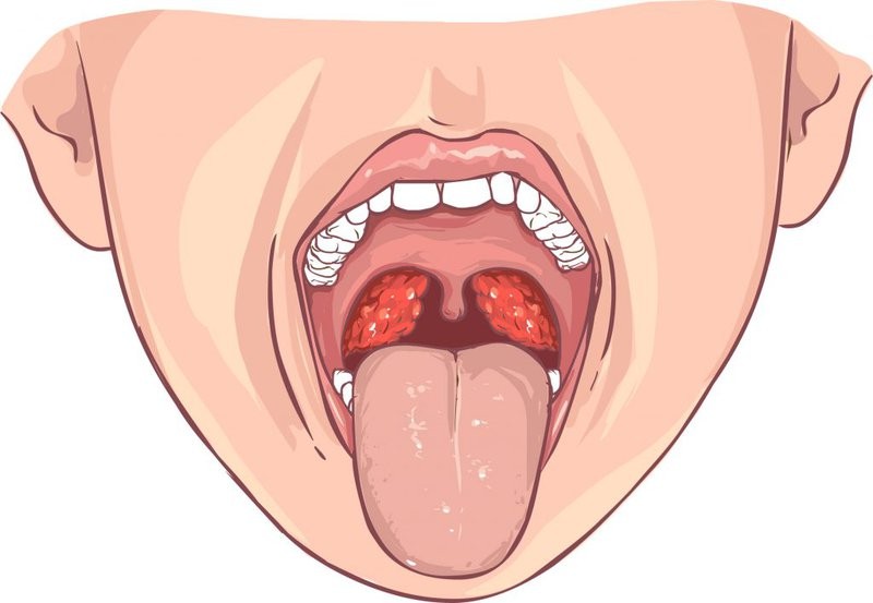 Amidan là một cặp khối mô mềm nằm ở phía sau cổ họng