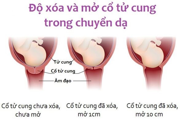 Độ xóa và mở của cổ tử cung trong quá trình chuyển dạ
