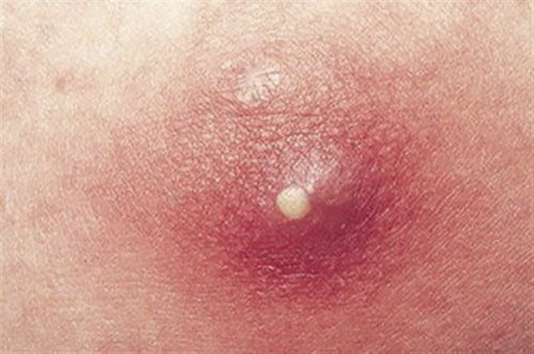Mụn nhọt ở mông: Nguyên nhân và cách điều trị hiệu quả