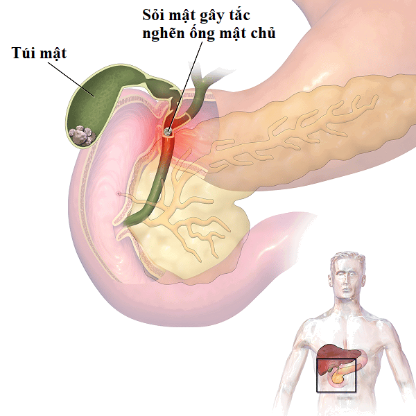 Sự hình thành của sỏi mật có thể gây tắc nghẽn đường dẫn mật