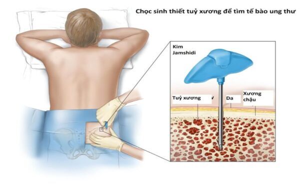 Chọc sinh thiết (hút) tủy xương để tìm tế bào ung thư 