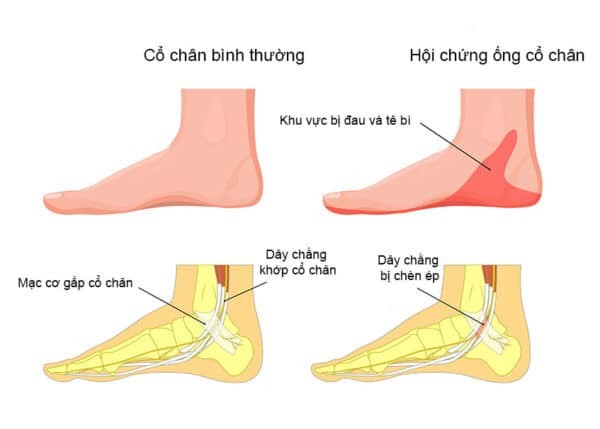 Phân biệt cổ chân bình thường và tình trạng hội chứng đường hầm cổ chân (ống cổ chân)