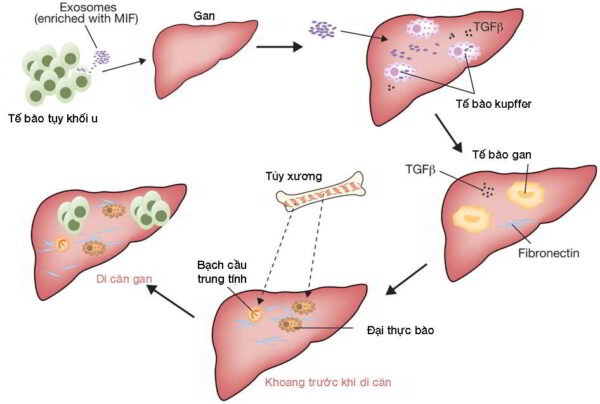 Các giai đoạn ung thư tụy di căn gan gây ung thư gan thứ phát