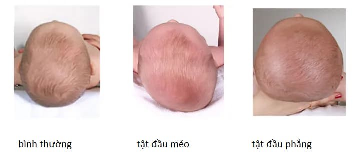 Phân biệt các dạng bẹp đầu ở trẻ sơ sinh
