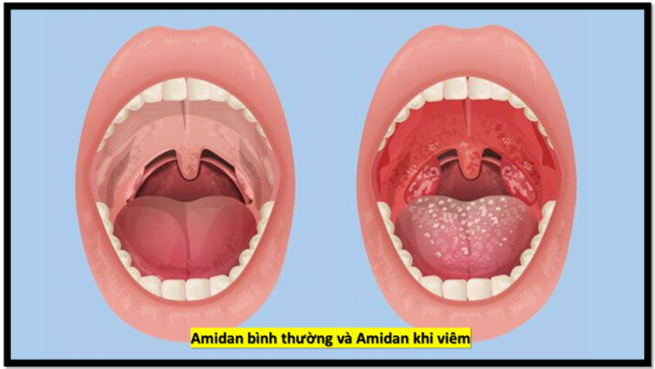Phân biệt amidan bình thường và amidan khi bị viêm