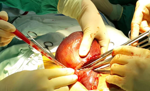 Phẫu thuật cắt bỏ phần gan bị tổn thương do ung thư