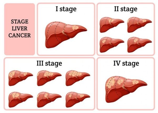 Tình trạng của gan qua các giai đoạn (stage) của bệnh ung thư gan