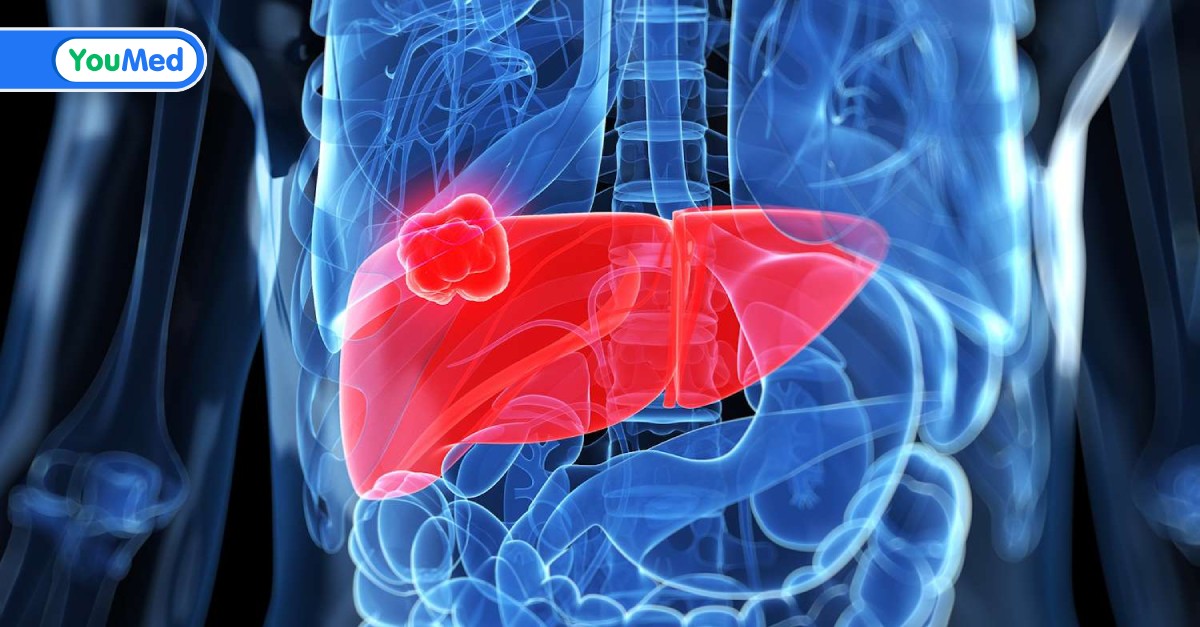 Cách phát hiện và chẩn đoán ung thư gan di căn phổi như thế nào?
