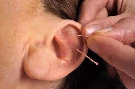 Châm cứu được ứng dụng làm giảm ù tai hiệu quả