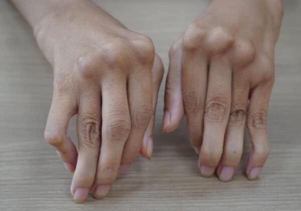 Viêm khớp dạng thấp ở tay là một trong những nguyên nhân gây đau khớp ngón tay