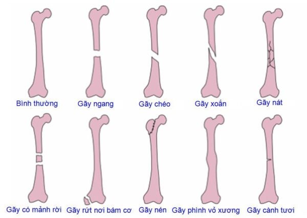Một số dạng gãy xương phổ biến thường gặp