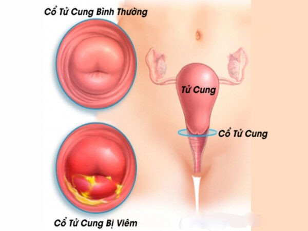 Viêm cổ tử cung là một trong những nguyên nhân gây tiểu buốt ở nữ giới