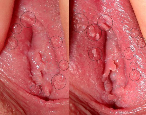 Các nốt sùi xuất hiện ở âm đạo là một dấu hiệu điển hình của sùi mào gà sinh dục