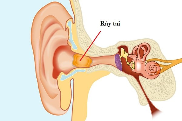 Ráy tai giúp dọn sạch chất bẩn cho tai