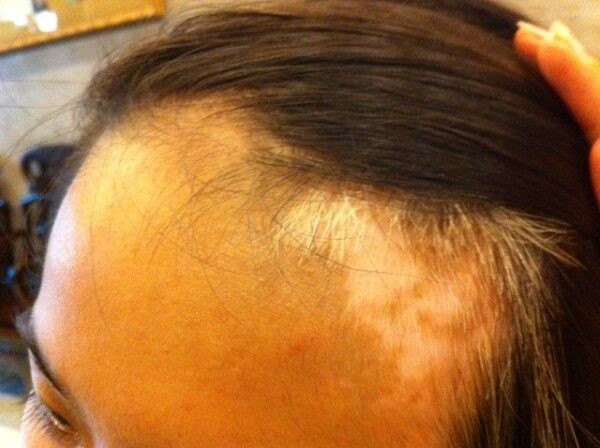 Các bệnh lý như bệnh bạch biến có thể gây tóc bạc sớm cho người bệnh 