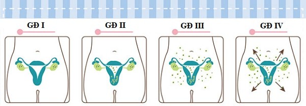 Ung thư buồng trứng sẽ phát triển qua 4 giai đoạn