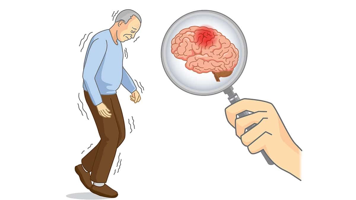Loại bệnh Parkinson và giới tính là các yếu tố ảnh hưởng đến tuổi thọ của bệnh nhân