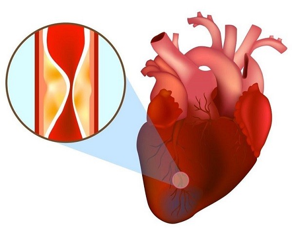 Nhồi máu cơ tim là một trong những biến chứng nguy hiểm nhất của tăng huyết áp