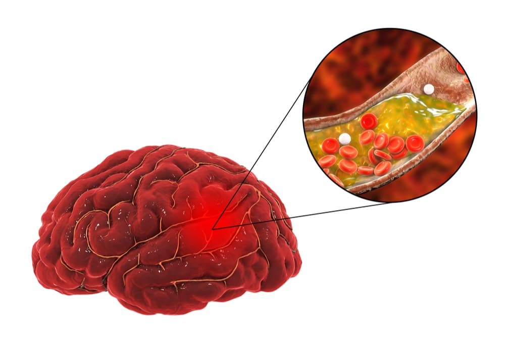 Thiếu máu não có thể là nguyên nhân gây đau nhức hai vùng thái dương ở đầu