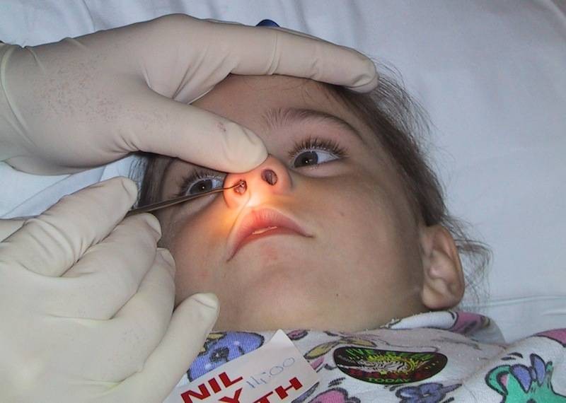 Dị vật ở đường thở là một trong những nguyên nhân thường gặp gây chảy nước mũi có máu ở trẻ