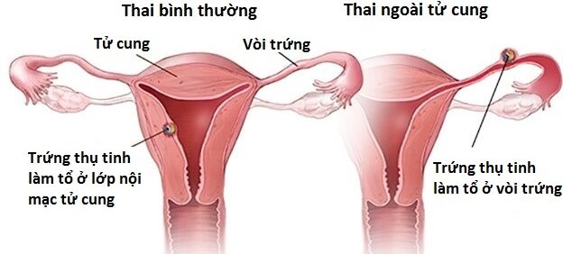 Mang thai ngoài tử cung là một nguyên nhân phổ biến gây đau bụng dưới và ra máu ở nữ