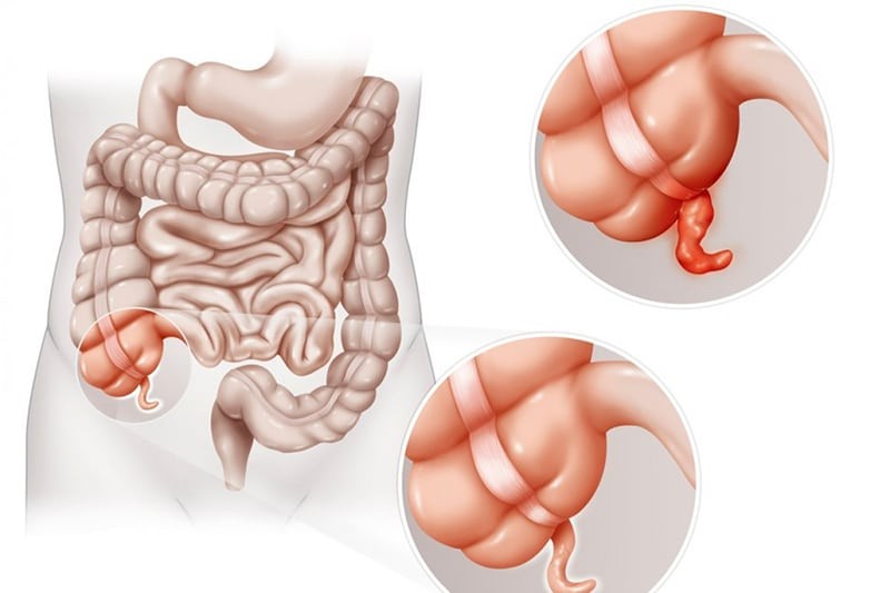 Viêm ruột thừa là một trong những nguyên nhân phổ biến gây đau bụng dưới bên trái