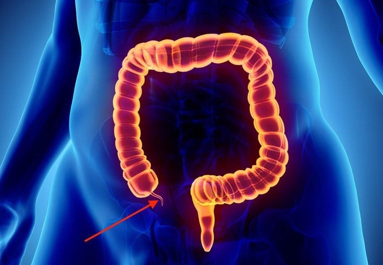 Viêm ruột thừa là một nguyên nhân phổ biến gây đau bụng dưới bên phải ở nam giới
