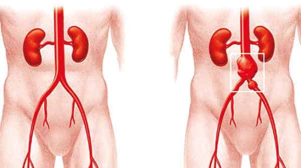 Phình động mạch chủ ở bụng là nguyên nhân gây đau tại khu vực bụng và lưng dưới