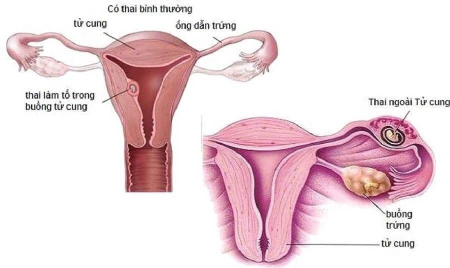 Thai ngoài tử cung là một trong những nguyên nhân gây ra triệu chứng đau bụng dưới