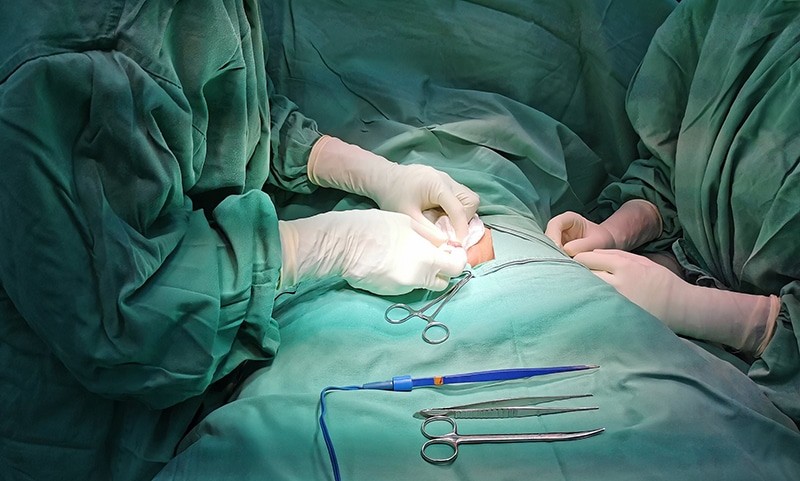 Phẫu thuật bao quy đầu là cắt bỏ da bao phủ đầu dương vật