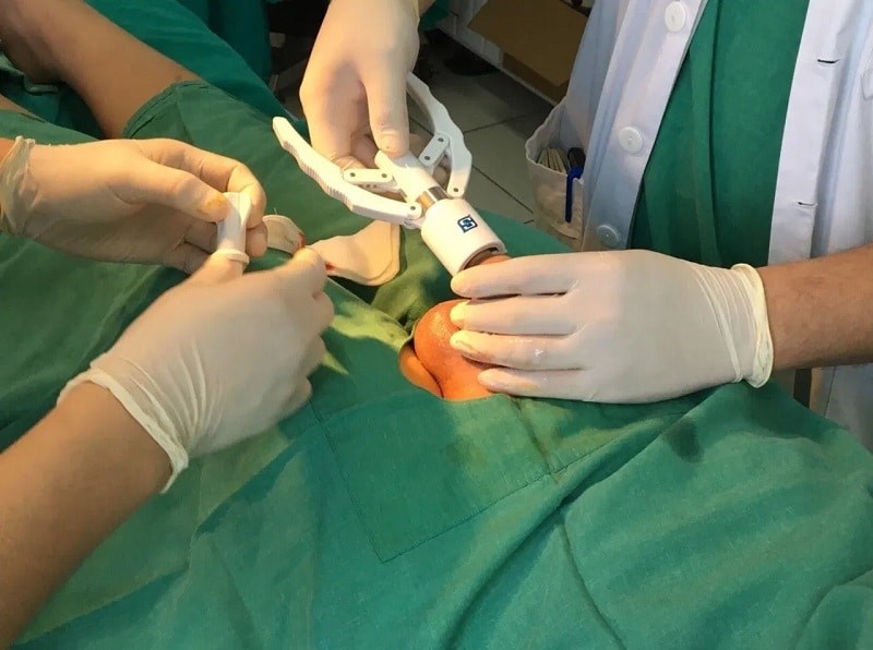 Phẫu thuật cắt bao quy đầu là phương pháp an toàn và hiệu quả