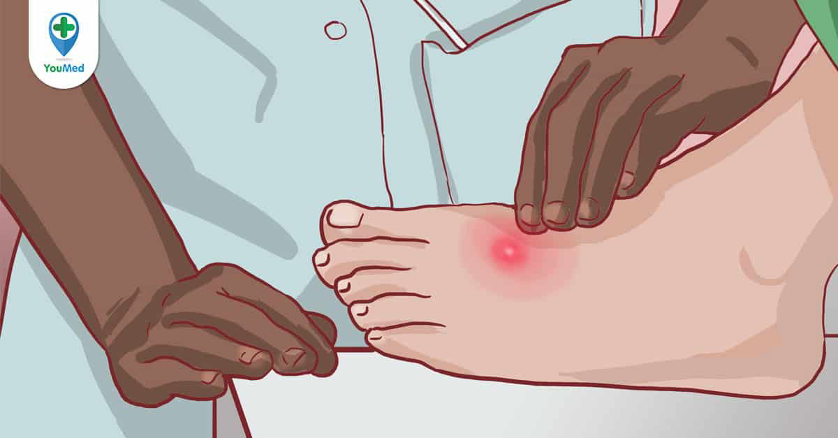 Tìm hiểu bệnh nổi mụn mủ ở chân dấu hiệu và cách điều trị