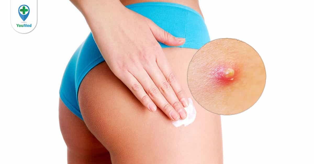 Làm thế nào để ngăn ngừa mụn nhọt ở mông?
